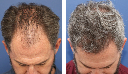  Before and After Picture 
47 year old male, 1 year after FUE transplant; 3000 grafts to the hairline and midscalp.
