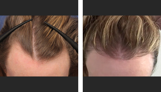  Before and After Picture 
35 year old female, 1 year after FUT; 2500 grafts to the hairline.
