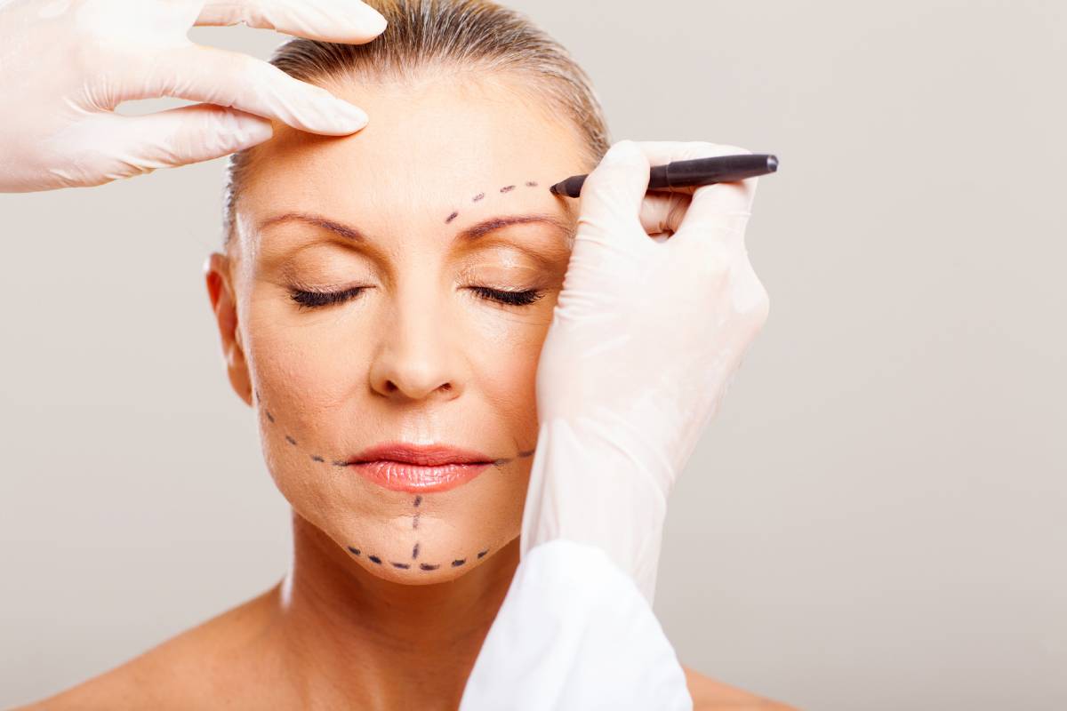 senior woman with correcting marks before face lift surgery