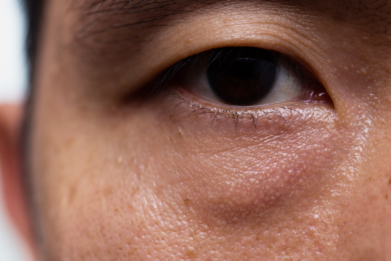 What causes droopy eyelids?
