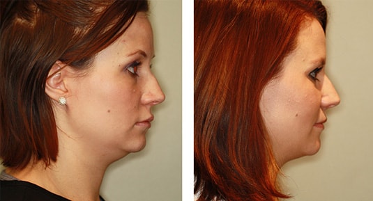  Before and After Picture  
26 Year Old Female - Kybella