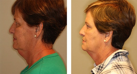  Before and After Picture  
63 Year Old Female - Kybella