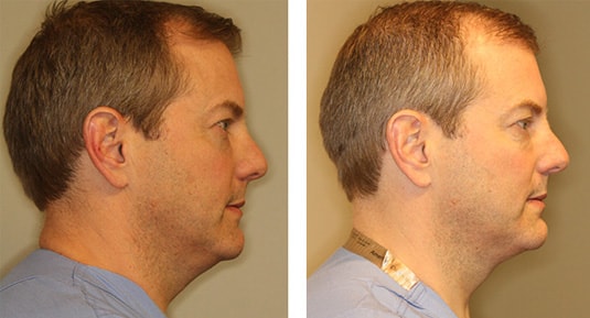  Before and After Picture  
46 Year Old Male - Kybella