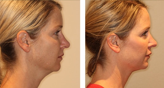  Before and After Picture  
44 year old female pre one kybella treatment