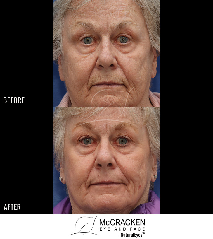 71 year old female – 5 Months after Full Face Sciton Laser Skin Resurfacing