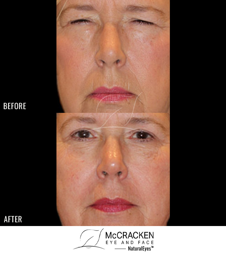 67 year old female – Full face fractional CO2 laser skin resurfacing Bilateral upper and lower lid blepharoplasty