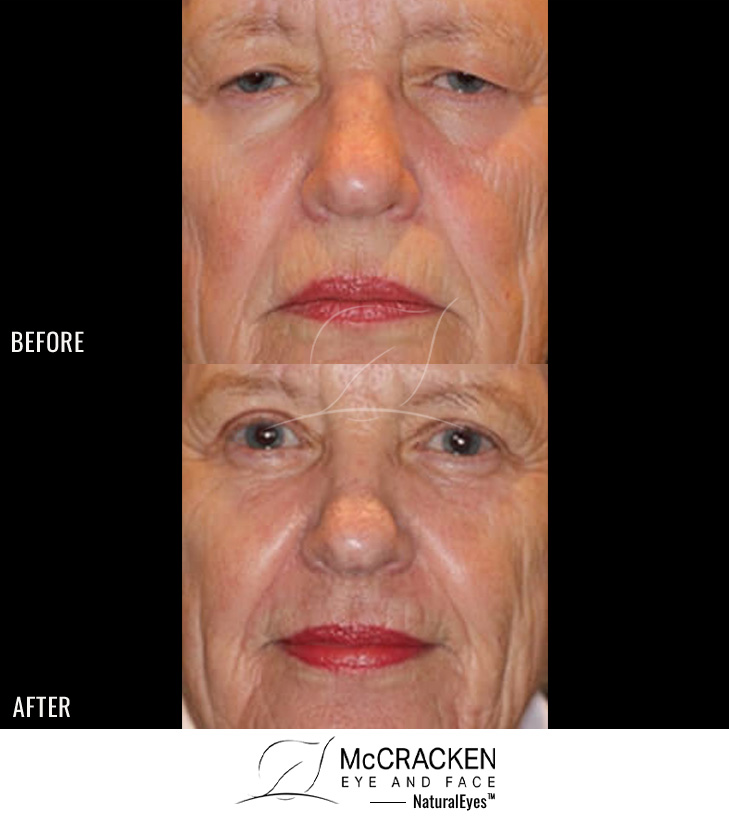 71 year old female – Full face fractional CO2 laser skin resurfacing, Bilateral upper lid blepharoplasty, Left brow lift