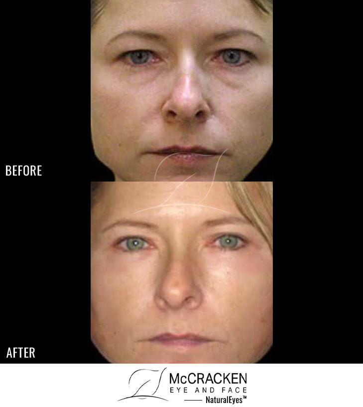 36 Year Old Female – Upper Blepharoplasty, Lower Eyelid Laser Resurfacing and Lower Eyelid Restylane®