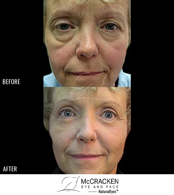 58 Year Old Female – Upper and Lower Blepharoplasty with Laser Resurfacing