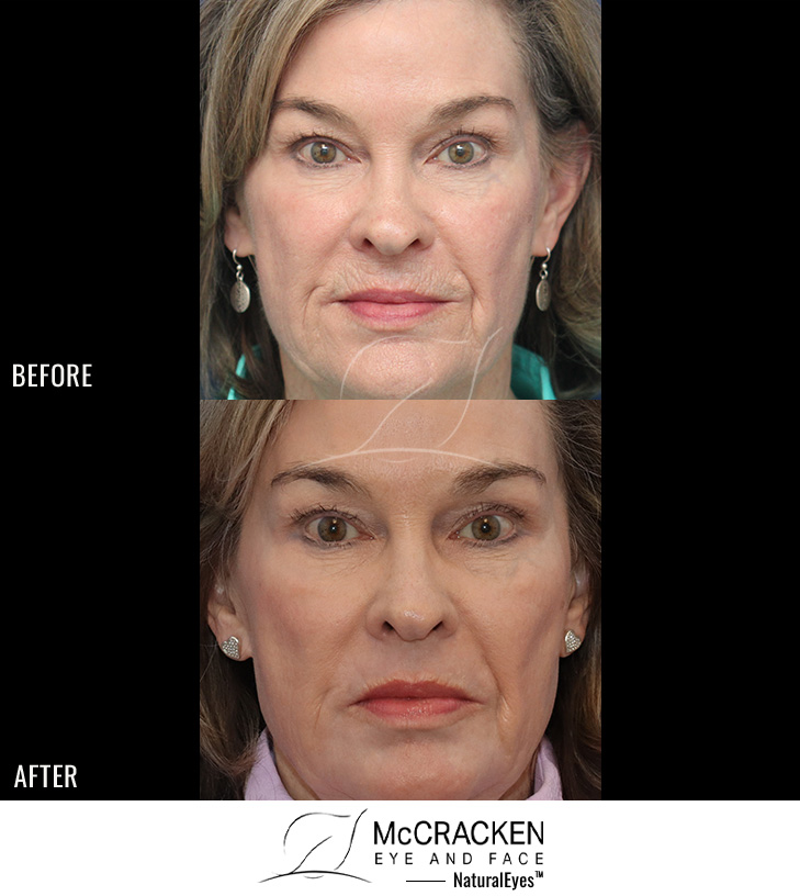 70 year old female – 5 Months after Perioral Sciton Laser Skin Resurfacing