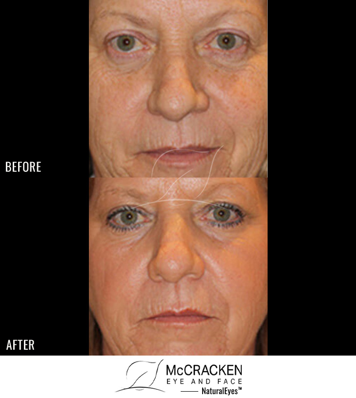 52 year old female – Full face fractional CO2 laser skin resurfacing
