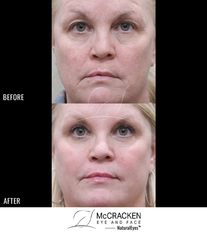 52 Year Old Female – Upper and Lower Blepharoplasty with Full Face Erbium Laser Skin Resurfacing.