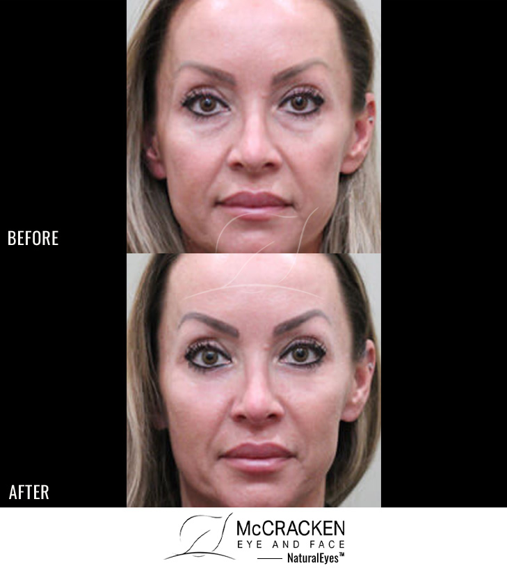 40 Year Old Female – Lower Blepharoplasty and Periocular Laser Skin Resurfacing.