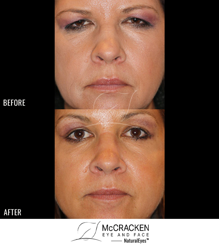 46 year old female – Full face fractional CO2 laser skin resurfacing, Endoscopic brow lift