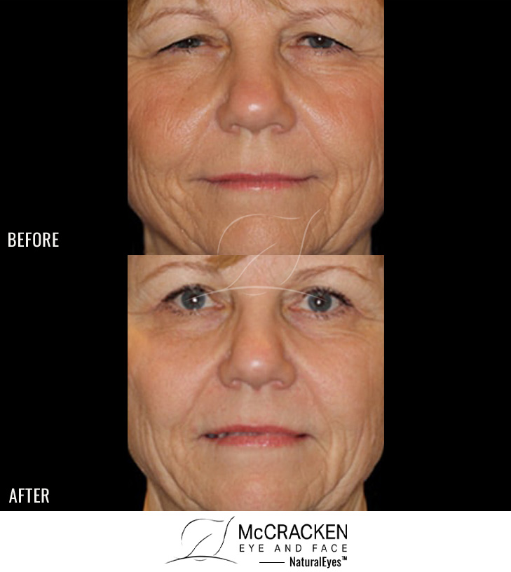 62 year old female – Full face fractional CO2 laser skin resurfacing, Bilateral upper lid blepharoplasty