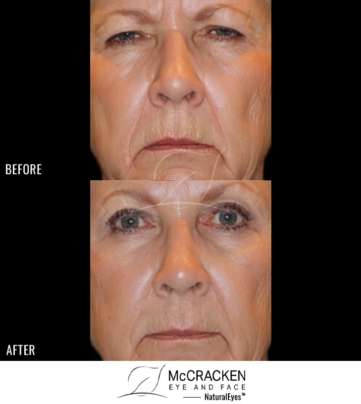 67 year old female – Full face fractional CO2 laser skin resurfacing, Bilateral endoscopic brow lift, Bilateral upper and lower lid blepharoplasty