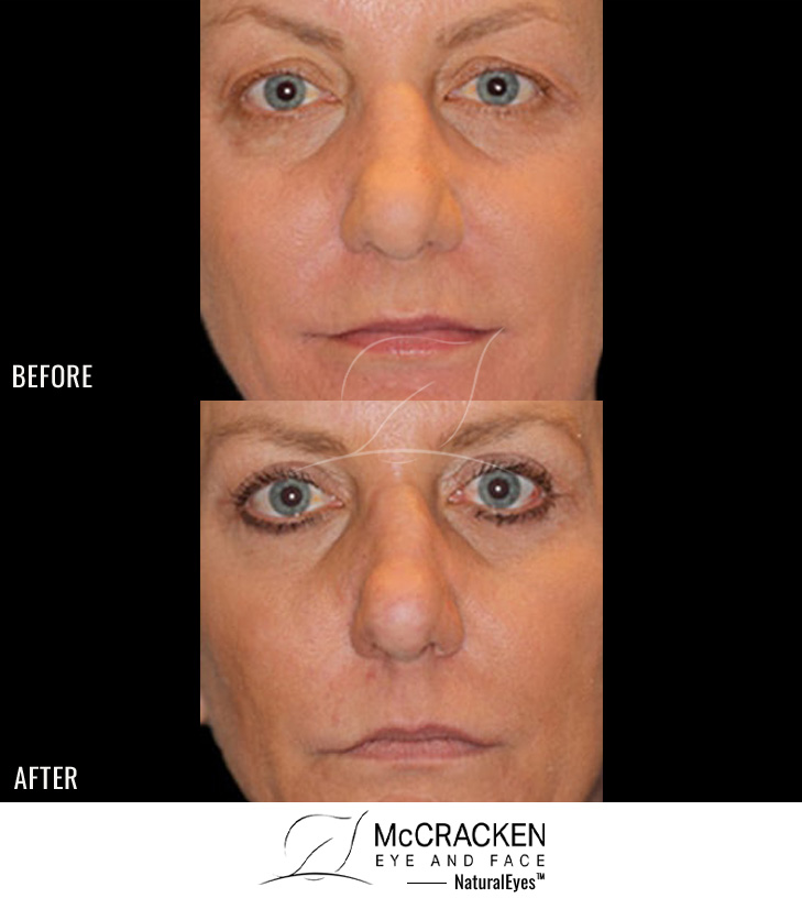 62 year old female – Bilateral upper and lower lid fractional, CO2 laser skin resurfacing, Bilateral upper lid blepharoplasty