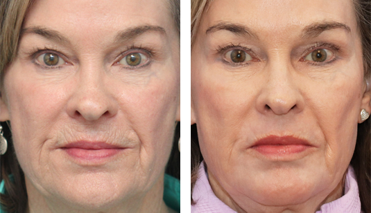  Before and After Picture 
70 year old female - 5 Months after Perioral Sciton Laser Skin Resurfacing