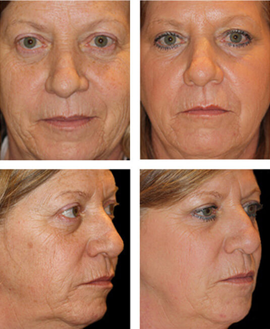  Before and After Picture 
52 year old female - Full face fractional CO2 laser skin resurfacing