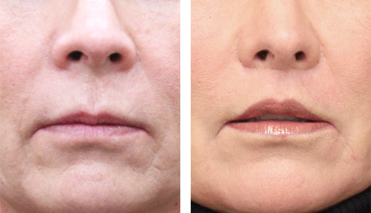  Before and After Picture 
60 Year Old Female – Lip Lift to Enhance the Upper Lip. No Filler Added.