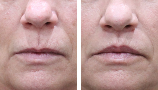  Before and After Picture 
61 Year Old Female - Lip Lift to Enhance the Upper Lip. No Filler Added.