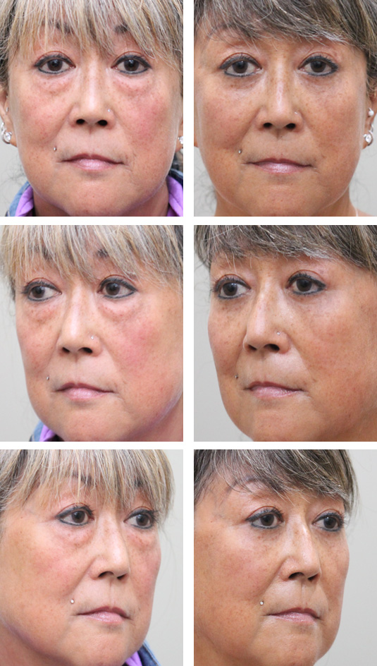 Before and After Picture 
61 Year Old Female - Lower Blepharoplasty