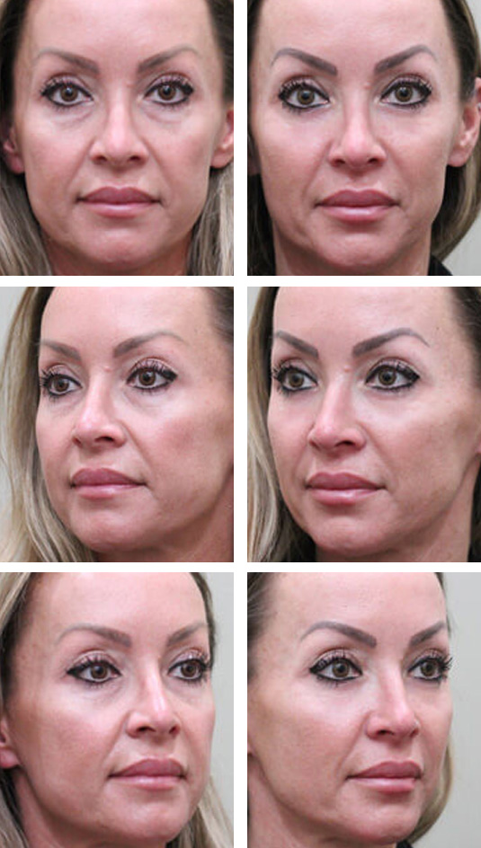  Before and After Picture 
40 Year Old Female - Lower Blepharoplasty and Periocular Laser Skin Resurfacing.