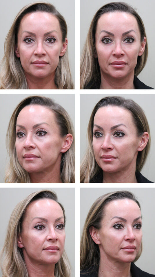  Before and After Picture  
40 Year Old Female - Lower Blepharoplasty and Periocular Laser Skin Resurfacing.