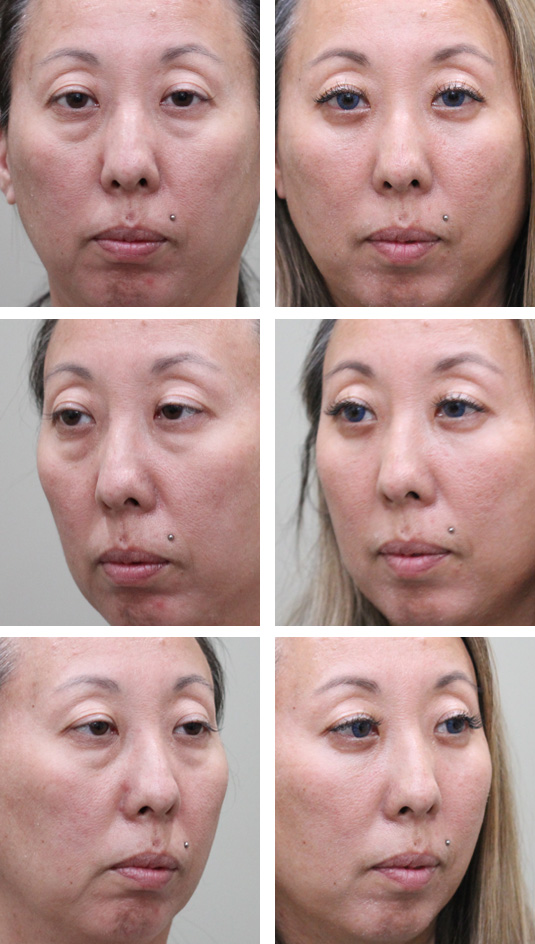  Before and After Picture 
41 Year Old Female - Lower Blepharoplasty with Transconjunctival Fat Repositioning and No Skin Incision