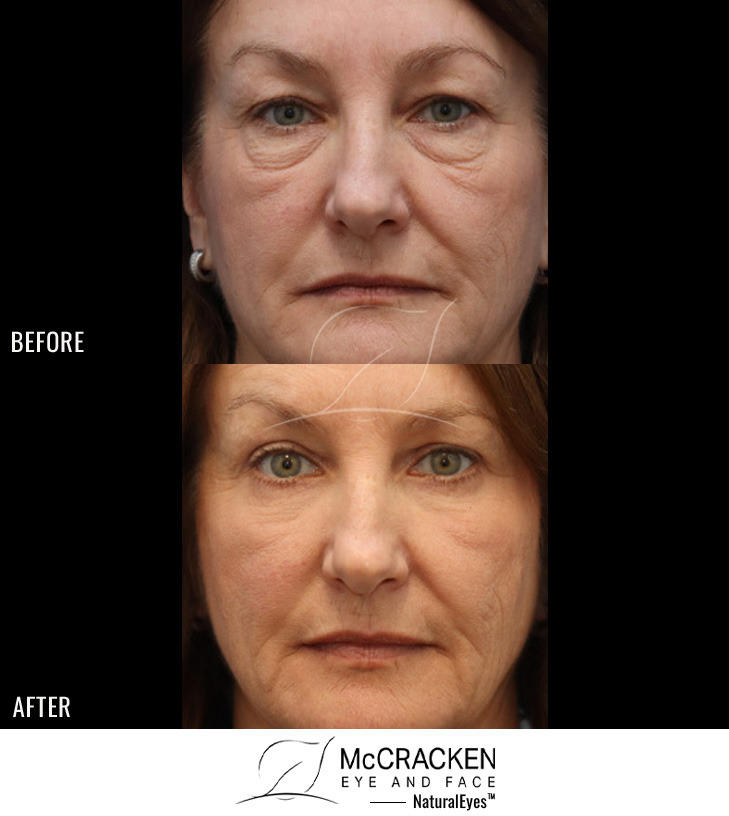 61 Year Old Female – Upper Lid Blepharoplasty, Lower Lid Blepharoplasty with Fat Repositioning and skin pinch excision, and AccuTite Radiofrequency Tightening to Malar Mounds(cheek swelling below the lower lids).