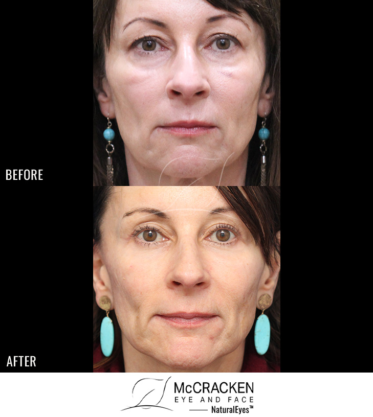 54 Year Old Female – Upper and Lower Blepharoplasty with Morpheus8 Radiofrequency Microneedling to Malar Mounds(cheek swelling below the lower lids). No lower lid skin incisions were made.
