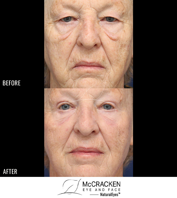 73 Year Old Female – Upper and Lower Blepharoplasty with Direct Excision of Festoons and Periocular Laser Skin Resurfacing. Because this patient had festoons (folded over skin and muscle on the cheek just below the lower lid) she had excision of the redundant tissue below the lower lid.