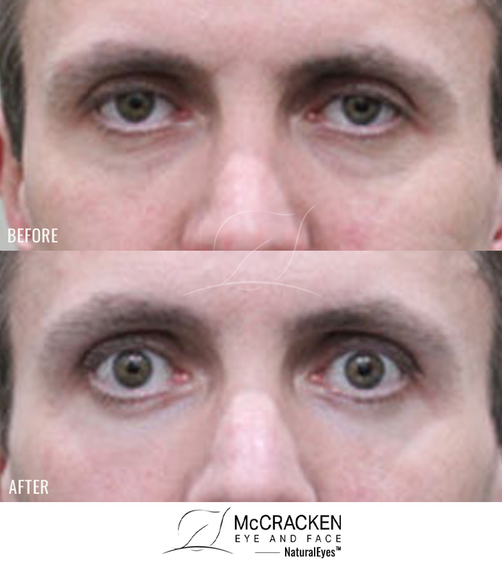 42 Year Old Male – Upper and Lower Blepharoplasty with Laser Skin Resurfacing. No skin incisions.