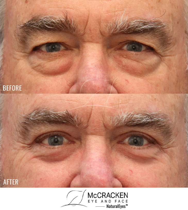 63 Year Old Male – Upper and Lower Blepharoplasty with Internal Brow Lift and Laser Skin Resurfacing. No lower lid skin incisions were made.