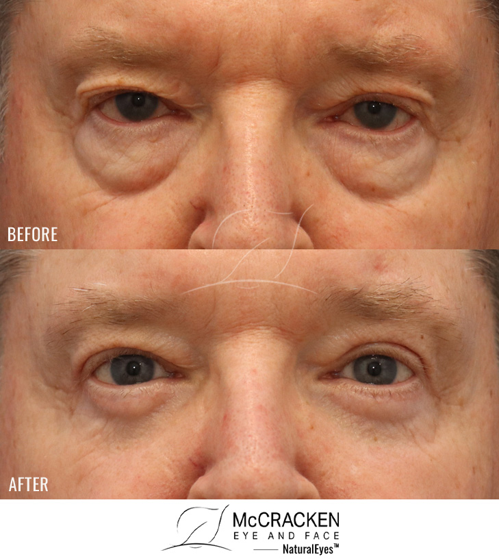 71 Year Old Male – Upper and Lower Blepharoplasty with skin pinch incision.