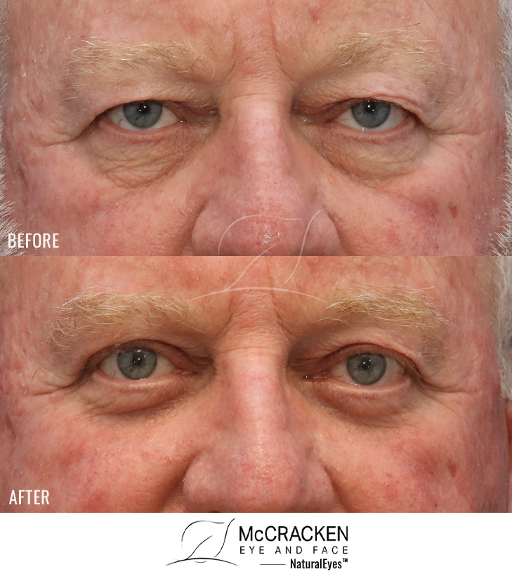 65 Year Old Male – Upper and Lower Blepharoplasty with fat injections (2cc on the right and 3cc on the left) and Laser Skin Resurfacing. No Lower Lid Skin Incisions.