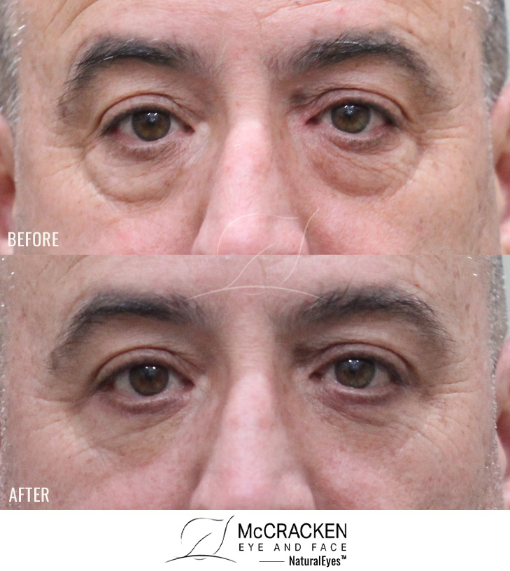 59 Year Old Male – Lower Blepharoplasty