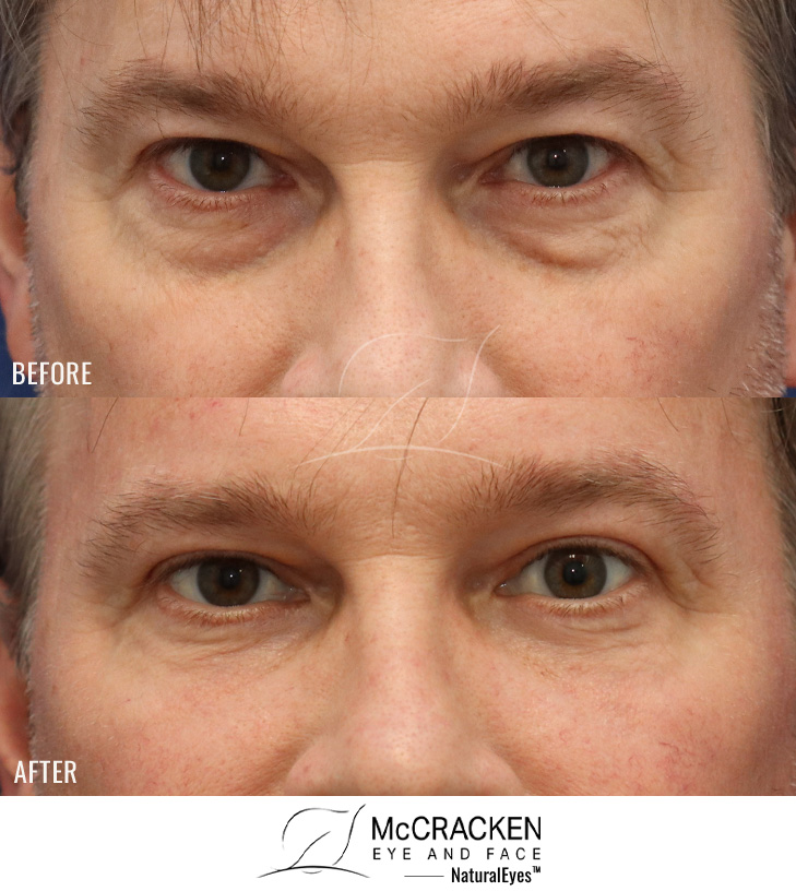 52 Year Old Male – Upper Lid Blepharoplasty with Brow Pexies, Lower Lid Blepharoplasty with Fat Repositioning and Injection of 3cc of Fat to each cheek. No Lower Lid Skin Incisions Were Made.