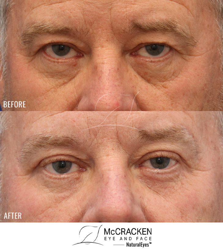 56 Year Old Male – Bilateral Direct Brow Lift, Upper and Lower Blepharoplasty, Fat injections to Cheeks (4cc R and 5cc L). A skin pinch excision was performed.