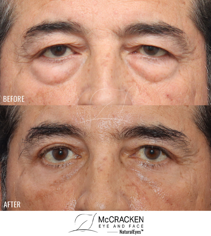 68 Year Old Male – Upper and Lower Blepharoplasty with Internal Brow Lift. No lower lid skin incisions were made.