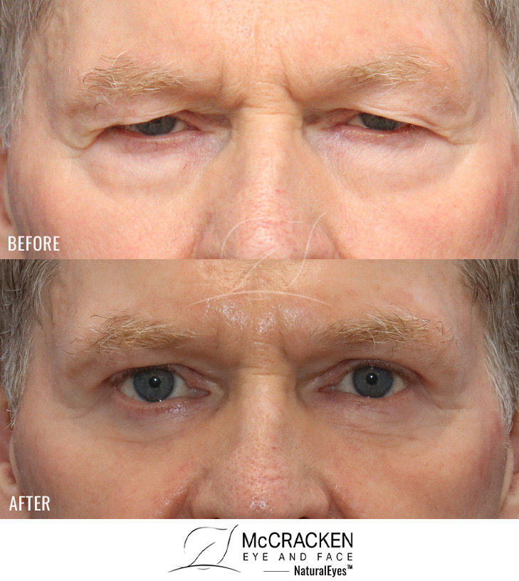 71 Year Old Male – Upper and Lower Blepharoplasty with Laser Skin Resurfacing. No lower lid skin incisions were made.