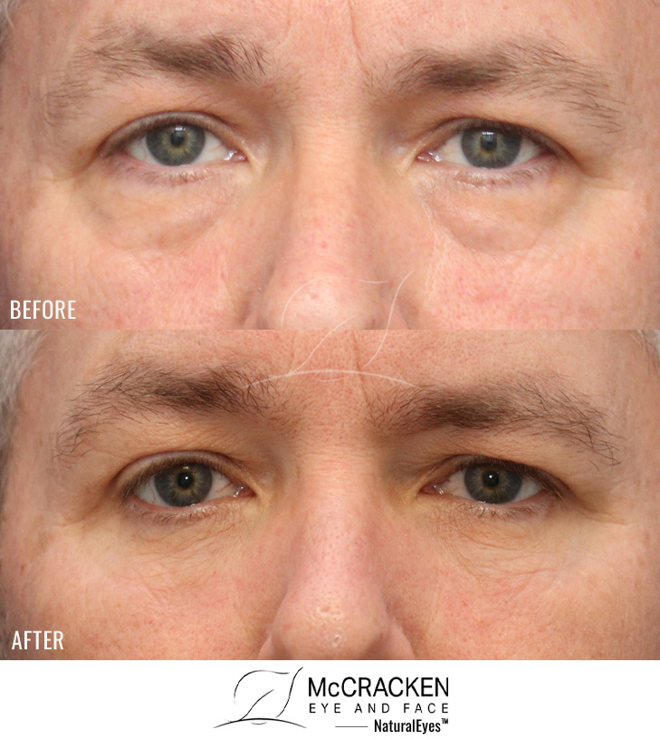 54 Year Old Male – Lower Blepharoplasty with AccuTite Radiofrequency skin tightening. No lower lid skin incisions were made.