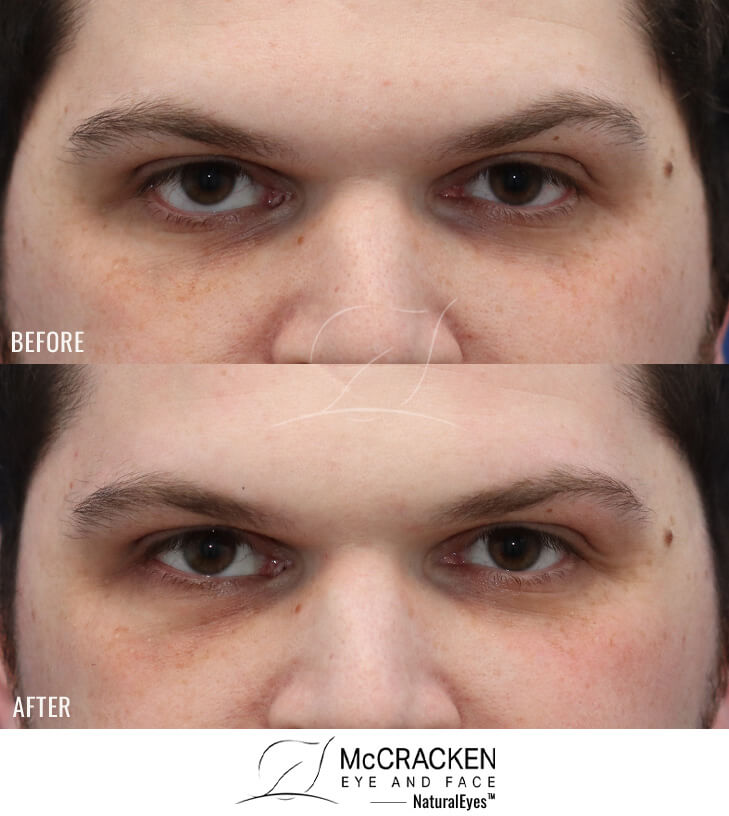31 Year Old Male – Repair of Right Lower Lid Retraction With EnduraGen Spacer Graft After Eyelid Surgery Elsewhere