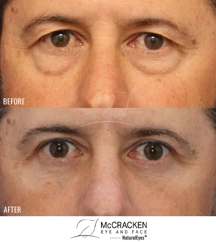 51 Year Old Male – Upper and Lower Blepharoplasty with Internal Brow Lift. No lower lid skin incisions were made.
