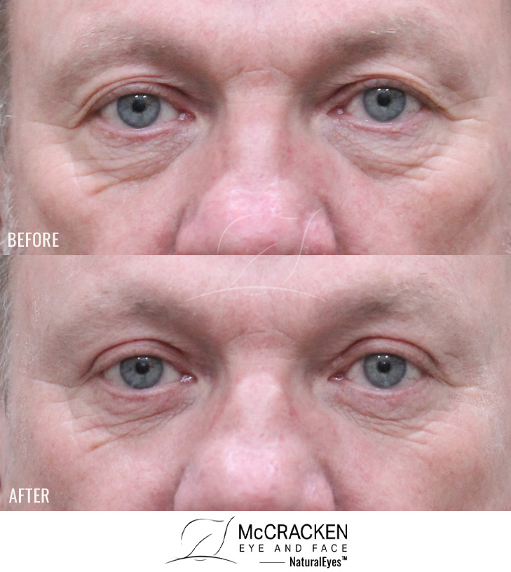 61 Year Old Male – Upper and Lower Blepharoplasty with lower lid skin pinch excision.
