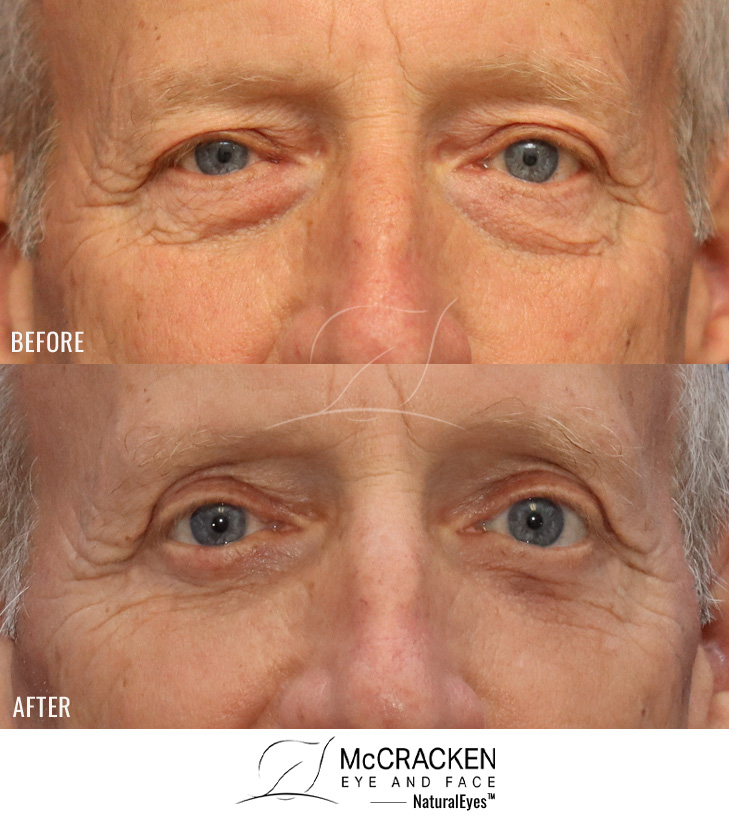70 Year Old Male – Upper and Lower Blepharoplasty with Internal Brow Pexies and Lower Lid Skin Muscle Flap Excision.