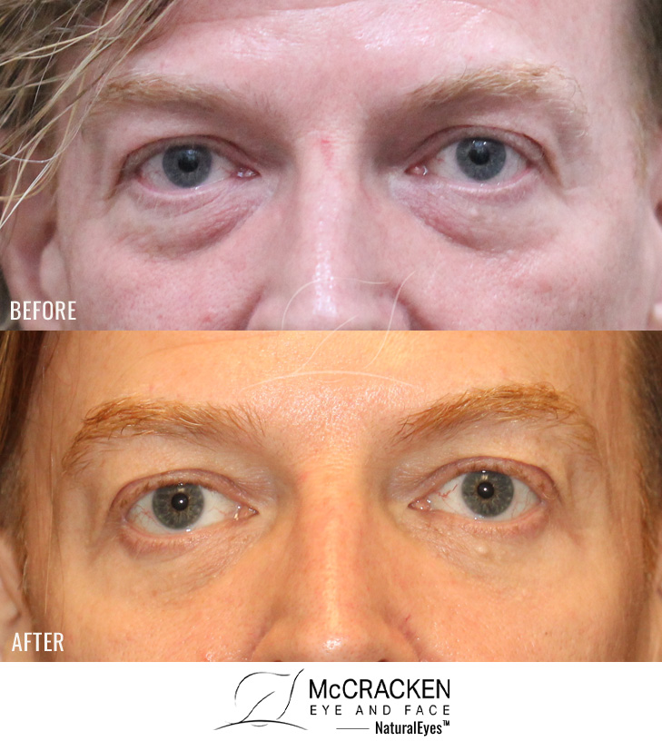 51 Year Old Male – Upper and Lower Blepharoplasty with Laser Skin Resurfacing. No skin incisions.