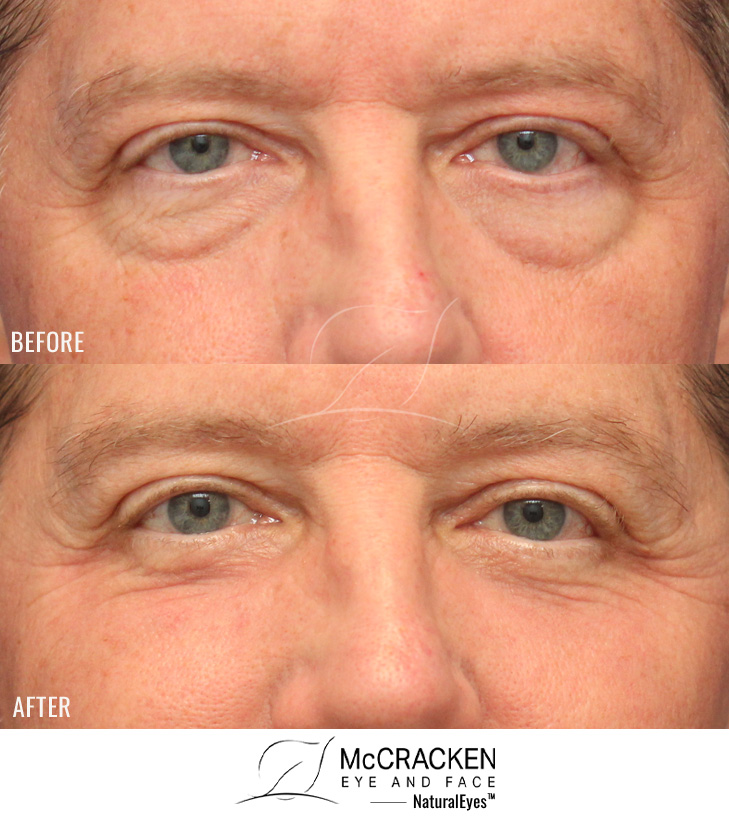 52 Year Old Male – Upper and Lower Blepharoplasty with Laser Skin Resurfacing. No lower lid skin incisions were made.