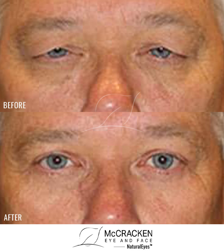 55 Year Old Male – Upper and Lower Blepharoplasty