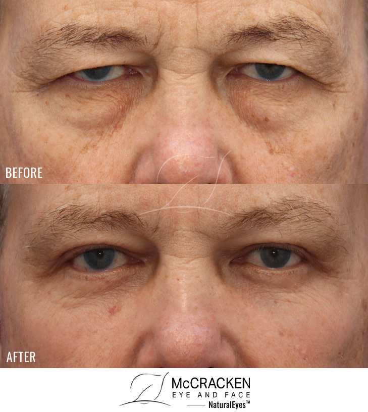 68 Year Old Male – Upper and Lower Blepharoplasty with Injection of 2.5cc of Fat into Each Cheek and Laser Skin Resurfacing